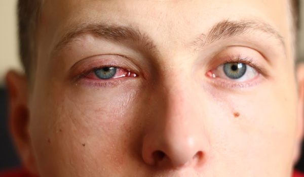 7 Tried & Tested Home Remedies For Pink Eyes