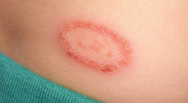 Essential Oils For Treating Ringworm Infections