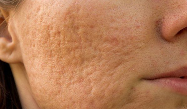 7 Best Essential Oils For All Types Of Scars