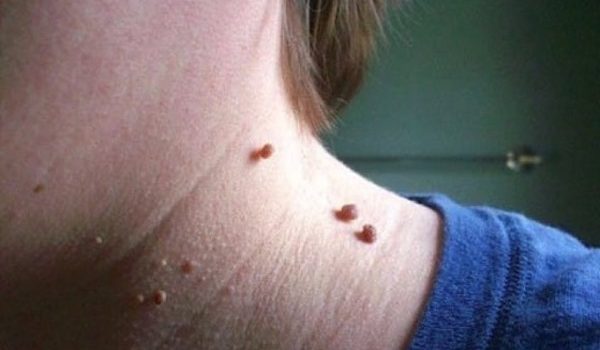 How Can You Get Rid Of Skin Tags Using Essential Oils?