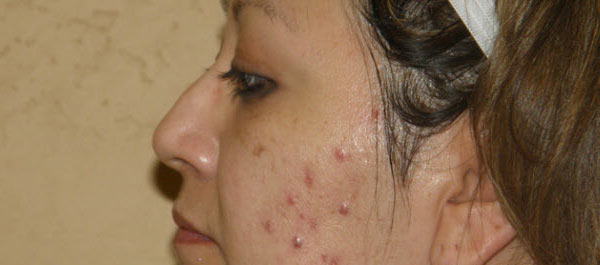 Adult Acne Problems? Here’s How You Can Deal With Hormonal Acne & Get Rid Of Them Naturally