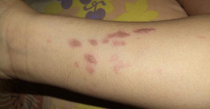 How to Deal with Minor Burns & Get Rid of Burn Scars?