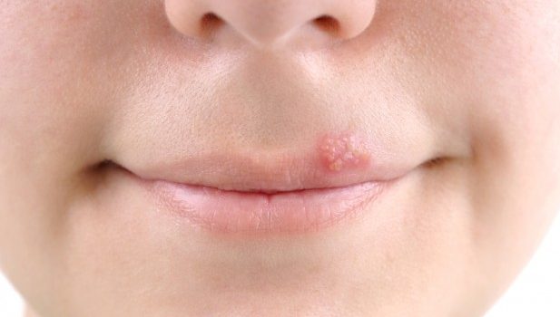 5 Best Essential Oils To Get Rid Of Cold Sores Quickly