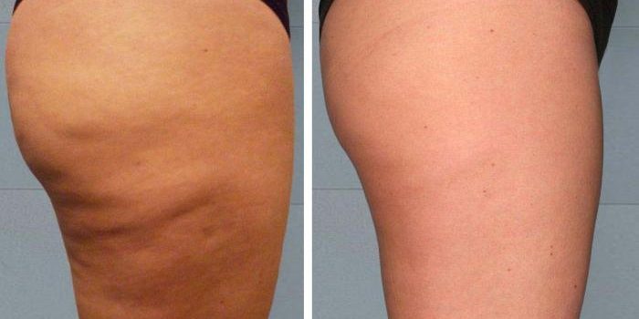 7 Best Essential Oils For Cellulite – Time To Get Rid Of Cottage Cheese Thighs