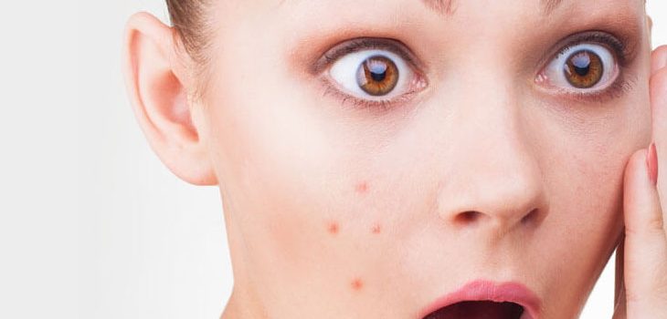 How to Use Hemp Seed Oil for Acne